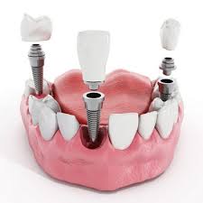 Dental implants cost - Full mouth dental reconstuction