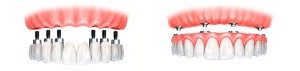 Removeable denture