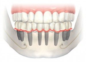 Click tite implant - overdenture