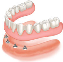 Click in denture: overdenture