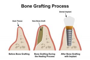 Dental bone graft