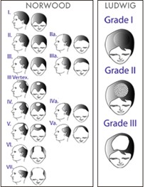 Ludvig / Norwood scale for hair transplants